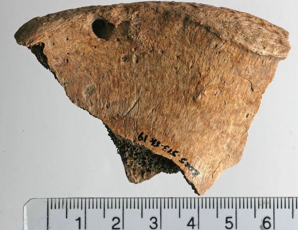 Lesions on the left iliac spine of the gladiator whose skeleton was uncovererd at a Roman-period cemetery outside York