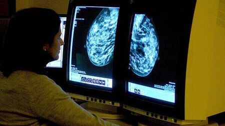 HSE says ‘problem’ with viewing BreastCheck register will be fixed next week