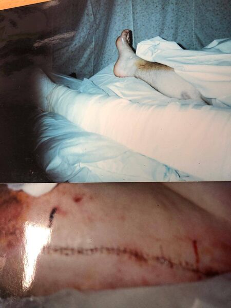 Barry suffered horrific injuries in a 2000 accident