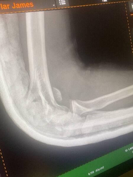 The X-Ray of the teen's fractured arm